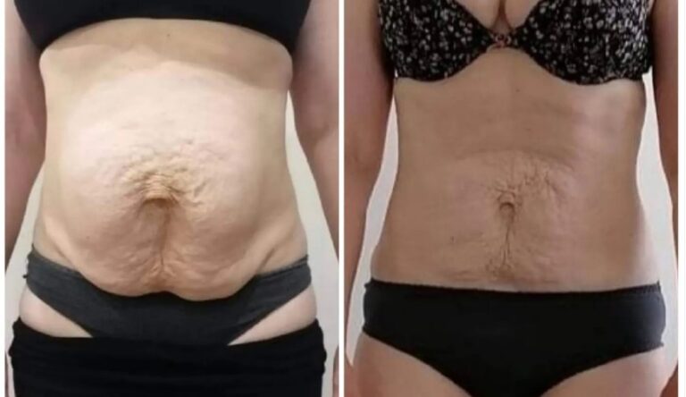 Diastáza, brušné hernie, únik moču, bolesti chrbtice + pooperačné stavy? Ako cvičiť a dýchať?