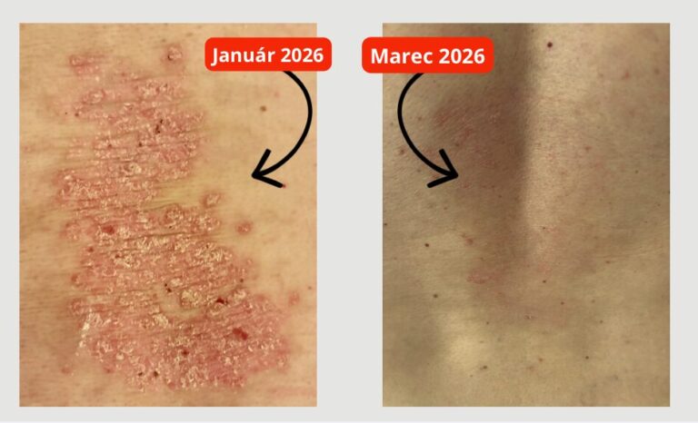 Ako sa zbaviť psoriázy a kožných problémov či zápalu? Táto kombinácia konečne zabrala!