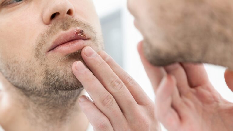 Herpes? Kto by ho chcel mať? Ako sa ho zbaviť za tri dni? Reálna skúsenosť čitateľa…